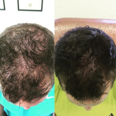 плазмолифтинг волосистой части головы фото до и после